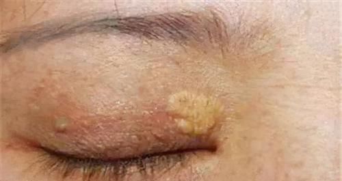眼睛边出现这种小肉粒，多半是血脂高了，饭后坚持一件事稳定血脂