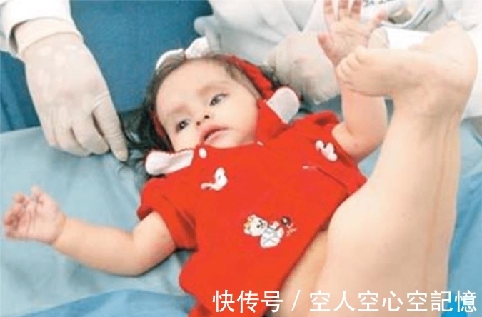 早夭|美国女孩出生患美人鱼症，喜欢在水里，生存十年创造医学奇迹