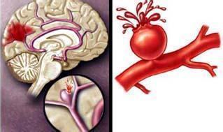 颅内压|脑出血就是脑溢血，医生提醒养成10个好习惯，脑血管才安全