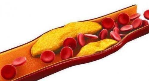 甘油三酯升高|甘油三酯过高,1植物泡水喝,甘油三酯降低了,头不晕手不麻