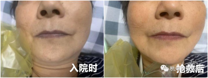 阿姨|全身发紫！这道很下饭的家常菜差点要了67岁阿姨的命