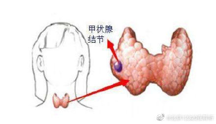 癌变|甲状腺结节会癌变吗？