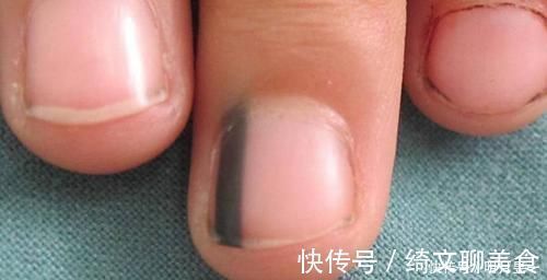 黑线|指甲里的黑线是什么?真有1种可能会癌变,不是开玩笑,别小瞧