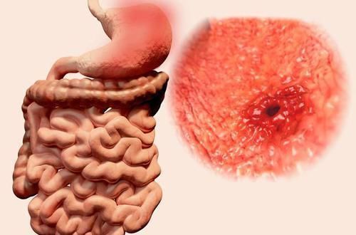 异常|医生告诫早期直肠癌的4个异常“变化”，你一个都不能忽视