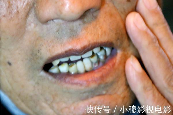 晚期|得了肝癌,身体常会有5个标志,若全占,说明可能已经到了晚期