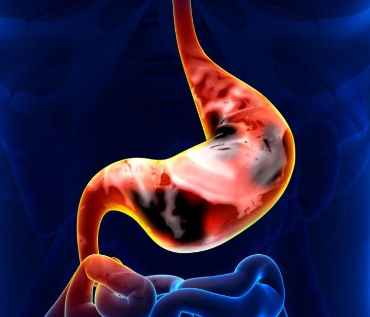 致癌物|我国胃癌的发病率为何很高？医生直言：答案可能会颠覆您的认知