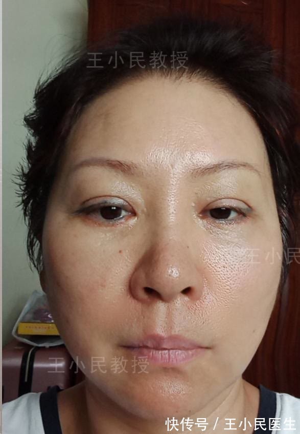 软组织 王小民教授:面部线条不流畅,松弛下垂的“赘肉”才是罪魁祸首!