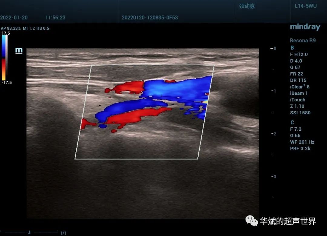 超声检查|典型病例?猎人弓综合征