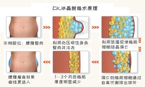 腹部 腹部吸脂手术多少钱？吸脂手术成功的关键是什么？