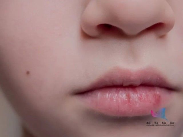毛细血管 嘴唇脱皮,还在撕死皮?撕皮一时爽,小心撕出唇炎…