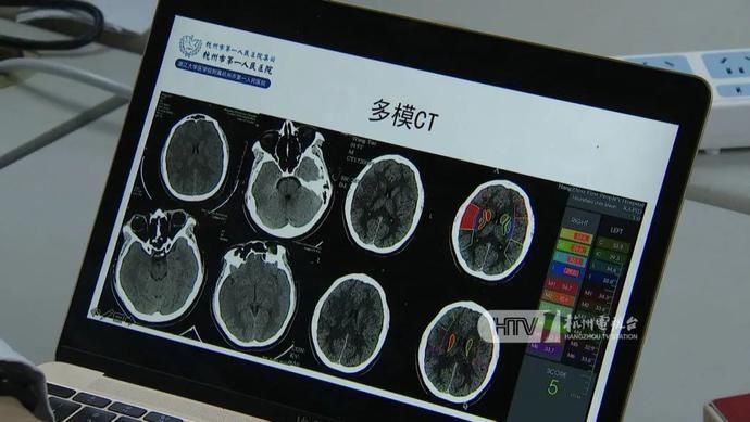中风|突然倒地!15岁男生成这家医院“年龄最小的”中风患者……他几乎没喝过白开水!