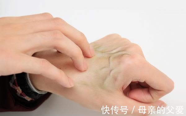 肝脏|肝不好的人,身体可能会出现“怪象”,常吃二物,或可有助改善