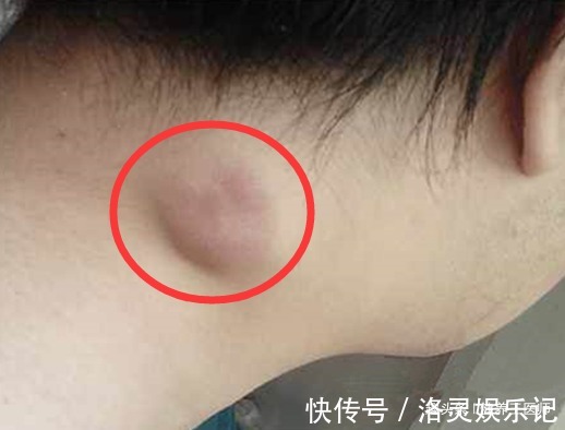 女性|女性有癌,脖子先知!脖子出现这种情况,建议你最好赶紧去检查!