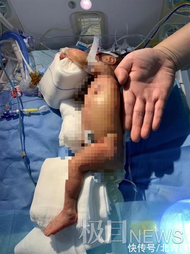 pd出生仅4天就要连闯三道生死关，多科室医生接力抢救这个“1公斤宝宝”
