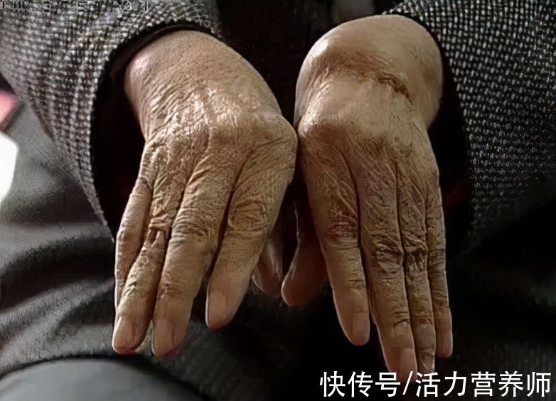 视力障碍|手指发麻是颈椎病吗?今天教你3个简单的判断办法,及时避免