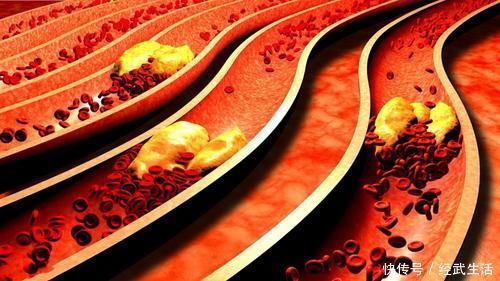 高血脂|42岁大叔,常年吃素,脑梗离世,医生叹息:吃2素食相当于在喝油