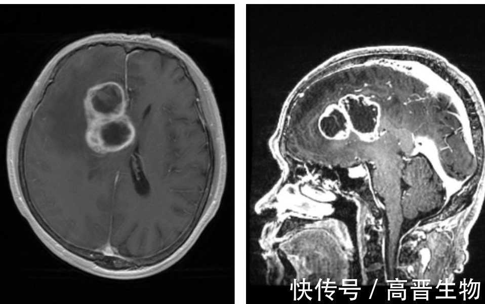 抗癌|BNCT是治疗胶质瘤最佳疗法?抗癌硼药是关键!