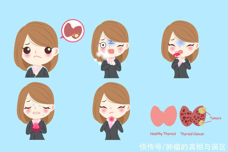 囊肿|体检报告中的结节、钙化、囊肿都是啥意思?手把手教你看懂