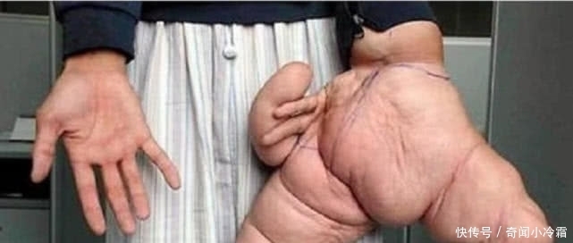 世界之最|吉尼斯世界之最:第2项由中国人创造的,为此还做了手术!