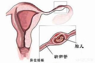 胚胎|为什么怀孕不到3个月,医生还让我做B超检查,有什么意义?