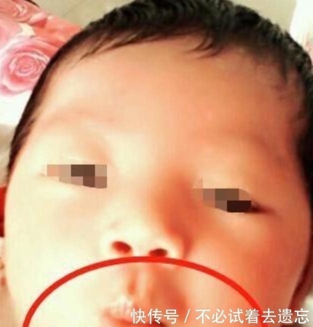 医院|3岁女儿撅“金鱼嘴”，妈妈不以为然夸可爱，奶奶却抱娃直奔医院