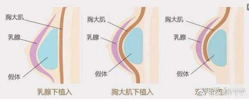 位移|担心假体隆胸会移位，如何防止假体隆胸移位？