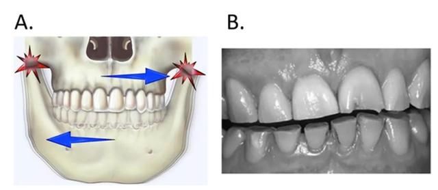牙齿|每晚默默“磨牙”的人，最终「磨」成了国字脸