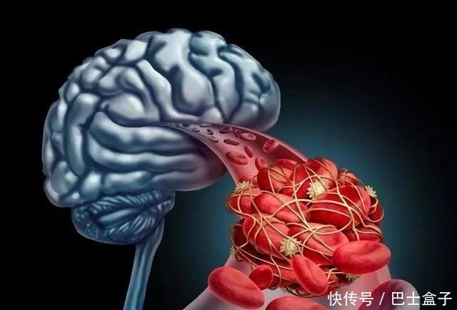 血压|冬季脑梗高发,多吃三物做好三事,疏通血管,防血栓