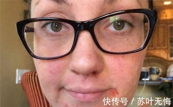 k女子患严重湿疹无法拥抱儿子 用剪刀刮掉皮肤