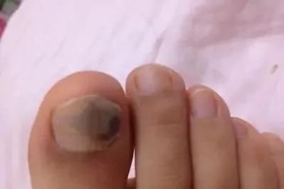 血脂升高|血脂高不高,看脚就知道,若没有这4种症状,恭喜,血管还算通畅