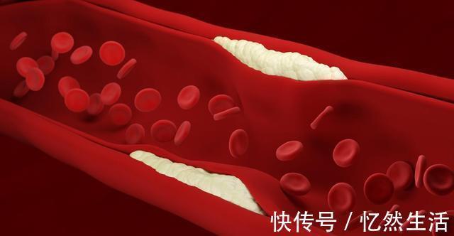 降血脂|血脂高都是肥肉造成的？医生：不是！这3物才是血脂的“加速器”