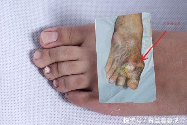  医生|医生两种食物称为尿酸催化剂，一口不沾的人，尿酸比较平稳