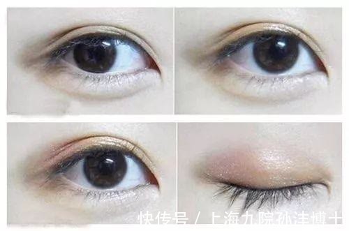双眼皮 眼修复孙沣博士:双眼皮术后出现分叉能修复吗?
