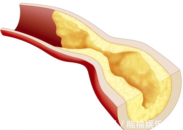 药物|治高血压有了新靶点，全球首个药物强效降压，保护心肾血管降尿酸