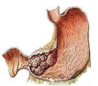 息肉|一定要看胃息肉会癌变吗?癌变几率有多大?