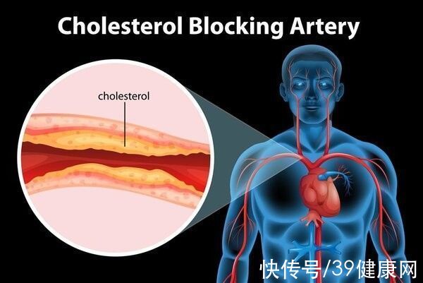 患者|房颤让中风风险高5倍！专家：坚持综合管理，帮你的心脏“减速”