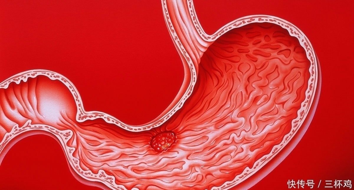 治疗|幽门螺杆菌最怕七种药物组合，坚持治疗十天，胃病会离你更远