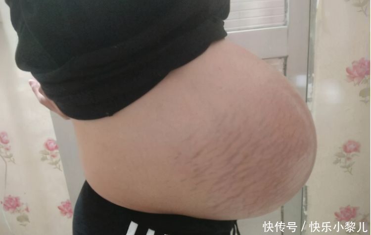宝妈|孕妇“悬垂肚”走红,头回见到这种胎型,护士坦言:对宝妈不好