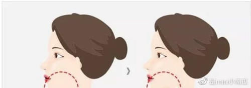 吸脂|下颌缘吸脂和双下巴抽脂有啥区别两个手术可以一起做吗?