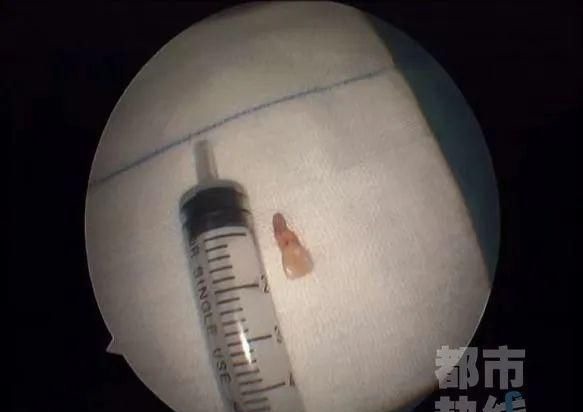 失踪|一6岁女童鼻子里“长牙”,取出后发现竟是三年前失踪的门牙