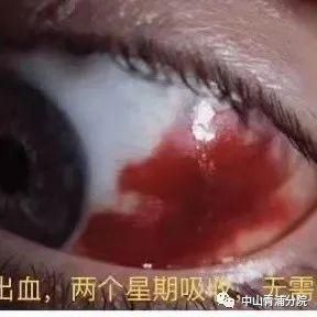 高度近视|眼睛出血，究竟可不可怕？