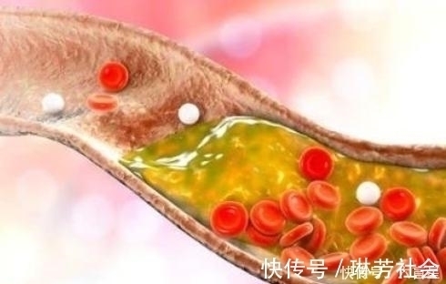 血管堵塞|高血脂''祸首''被揪出！烟酒仅排最后，若你常吃，血管堵塞更严重