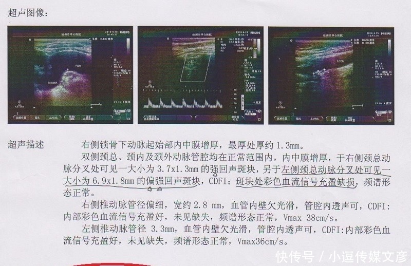 脖子上长了这个东西要当心！医生：多数脑梗都是因它而起！