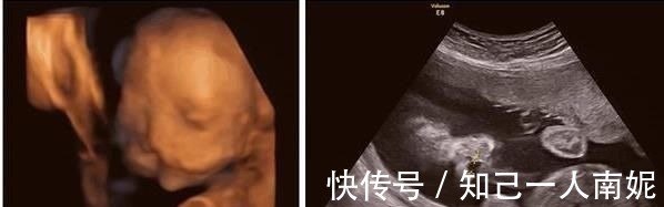 小郭|妻子怀孕看B超以为双胞胎,欣喜若狂,但孩子出生后,全家乱了套