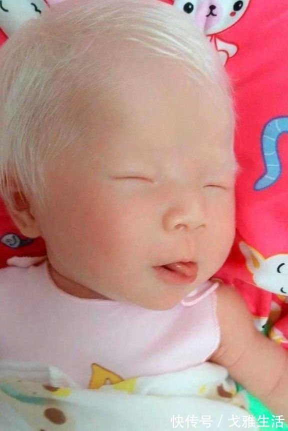 白化病|孕妇产下孩子一头白发,医生却说没什么!