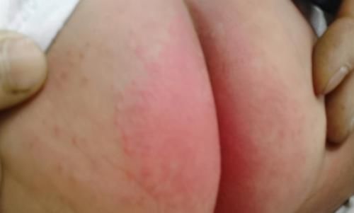 屁屁|婴儿“红屁屁”住院20多天,差点要植皮,医生:都是家长粗心闹的