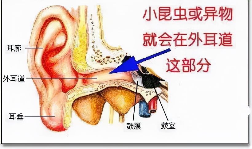 异物|异物入耳别乱掏，这些做法后果可能更严重！耳鼻喉科医生总结4类正确处理方式