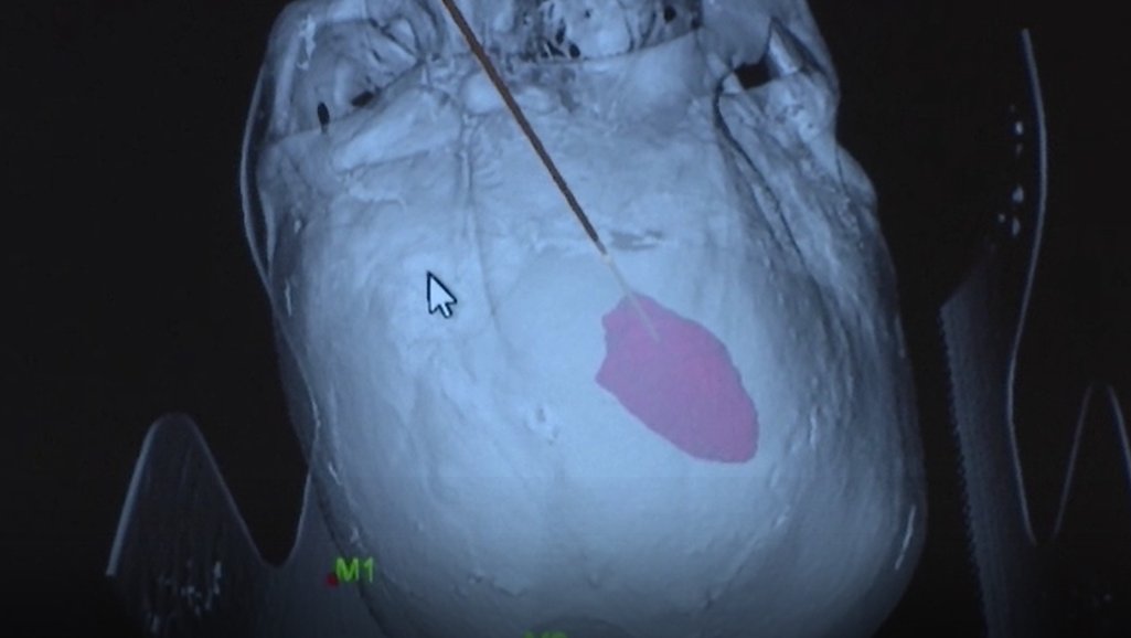 神经外科|“空中”手术室来了 5G+机器人将200公里外血肿清除
