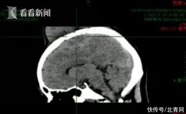 女子|偏信游医“土方法”女子头顶长出菠萝大肿瘤