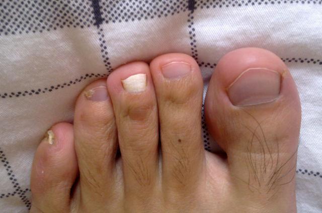 罹病率|脚趾有3种变化，说明身体有问题了，若没有，说明你还算健康！